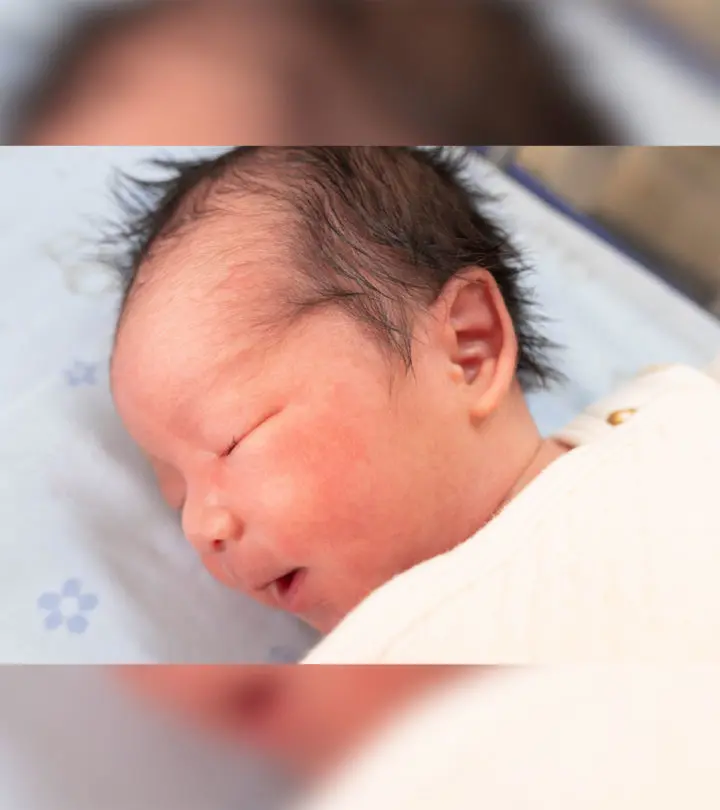 New Article What Causes Caput Succedaneum Swelling On The Head In Newborns