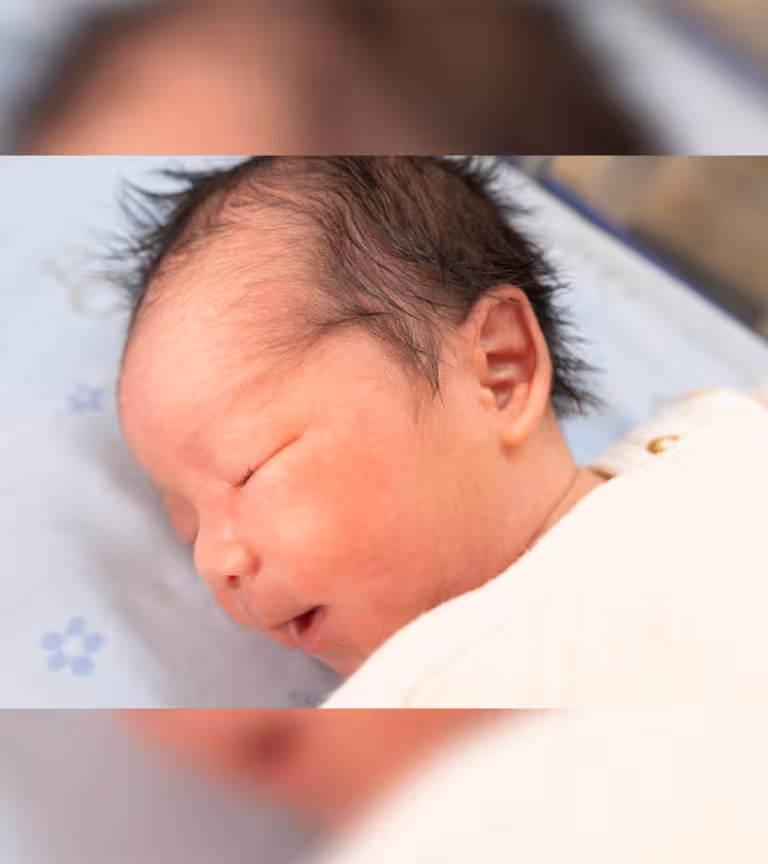 New Article What Causes Caput Succedaneum Swelling On The Head In Newborns