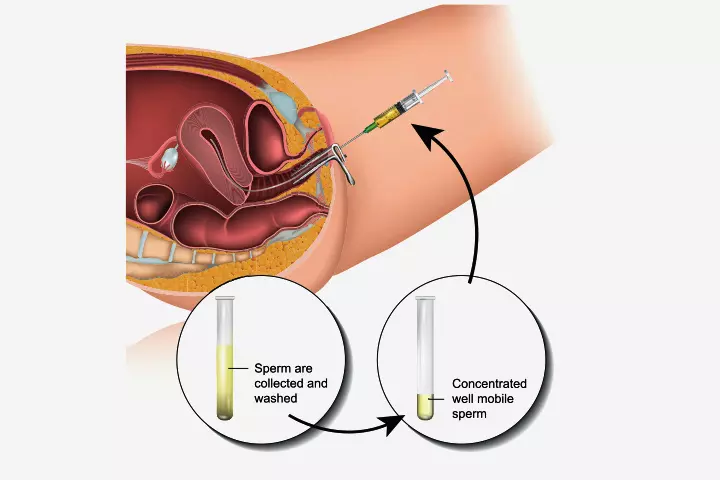 What is uterine fertilization