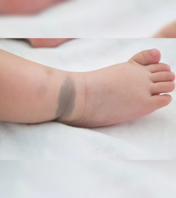 बच्चों में बर्थमार्क (जन्म चिह्न): कारण, प्रकार व प्रभाव | Birthmark In Babies In Hindi_image