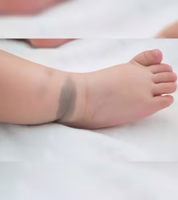 Birthmark In Babies In Hindi