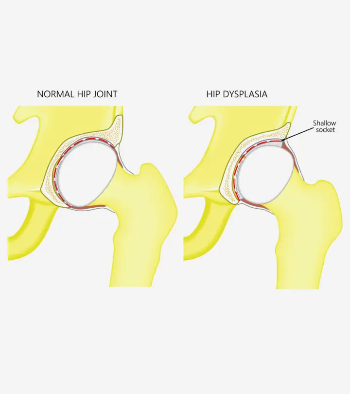 Many factors increase hip dysplasia risk, which may be treated surgically or non-surgically.