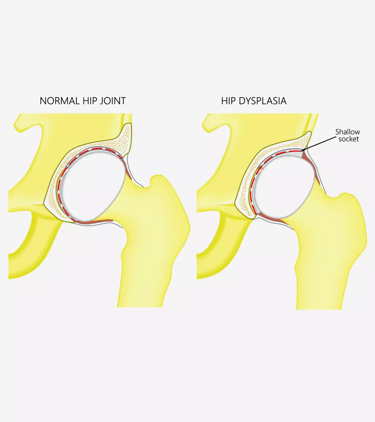 Many factors increase hip dysplasia risk, which may be treated surgically or non-surgically.