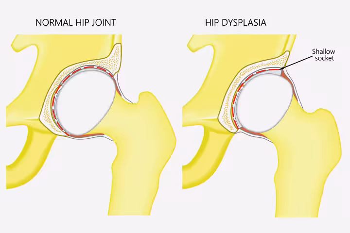Hip Dysplasia In Babies Causes Signs And Treatment