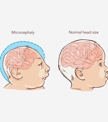 Genetics, infections, and other external factors may cause microcephaly in babies.