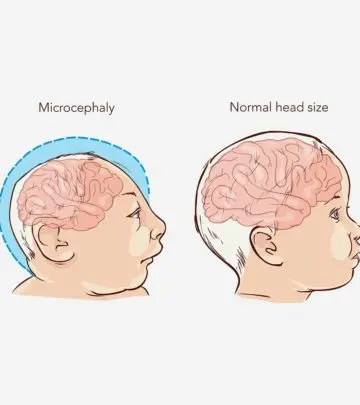 Genetics, infections, and other external factors may cause microcephaly in babies.