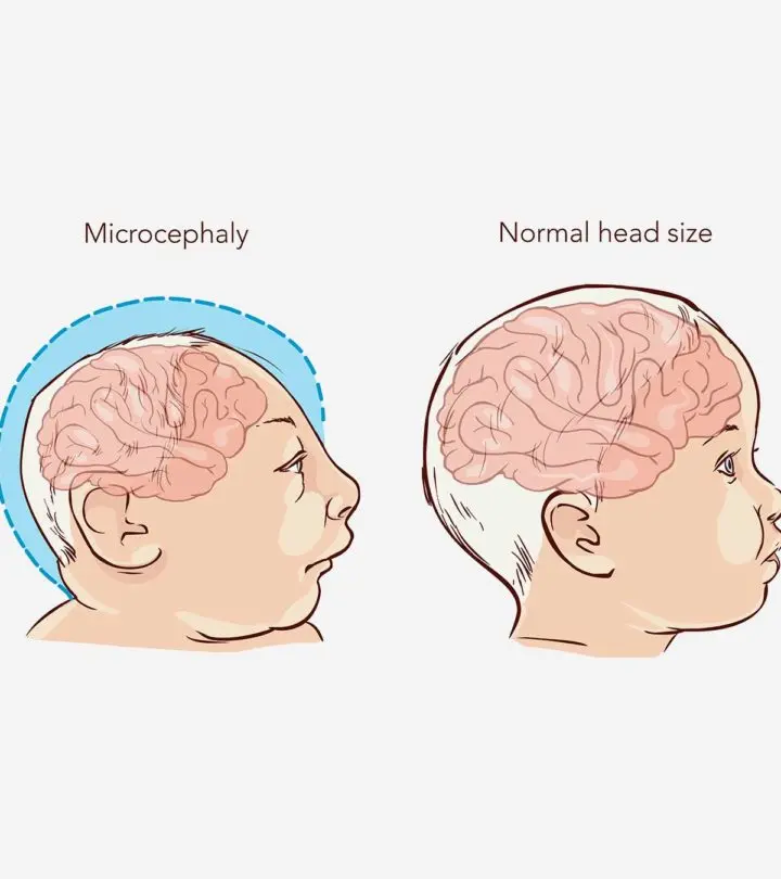 Microcephaly In Babies: Causes, Symptoms And Treatment