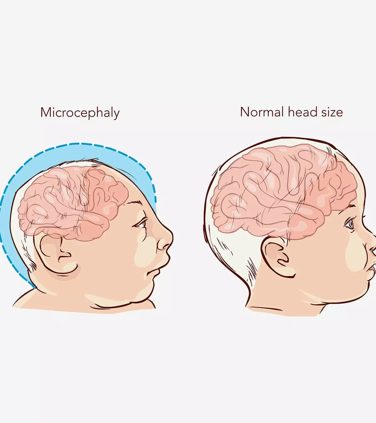 Genetics, infections, and other external factors may cause microcephaly in babies.