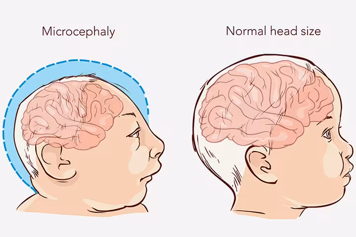 Microcephaly In Babies: Causes, Symptoms And Treatment