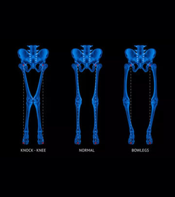 From different knee shapes to weak muscles- the symptoms of rickets in children are many.