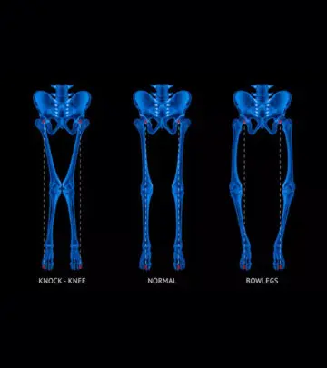 From different knee shapes to weak muscles- the symptoms of rickets in children are many.