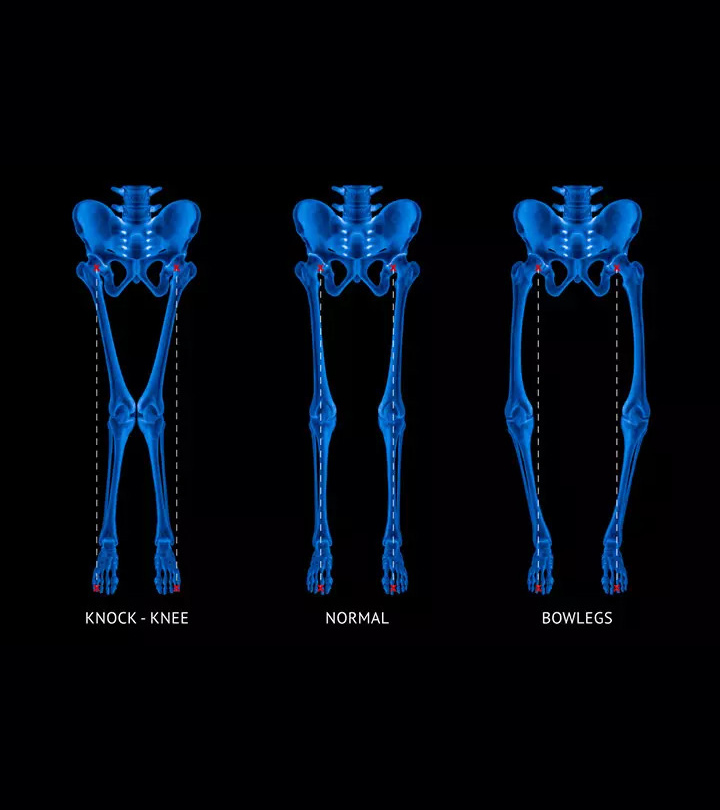 Rickets In Children Signs, Symptoms, Causes And Treatment