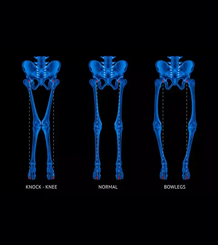 From different knee shapes to weak muscles- the symptoms of rickets in children are many.