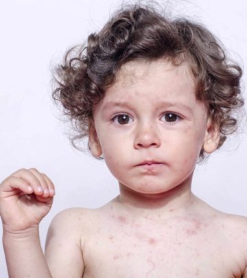 बच्चों में रूबेला (खसरा) के लक्षण, टीकाकरण व उपचार | Rubella In Kids In Hindi_image