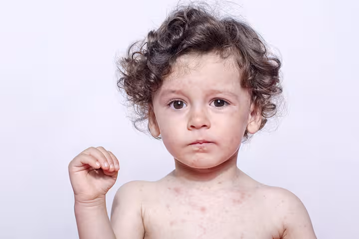 Rubella In Kids In Hindi