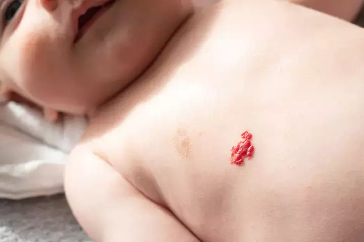 Strawberry Hemangiomas