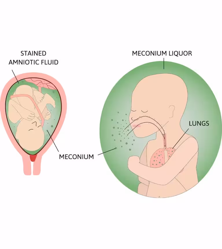 What is Meconium Aspiration Syndrome Causes And Treatment