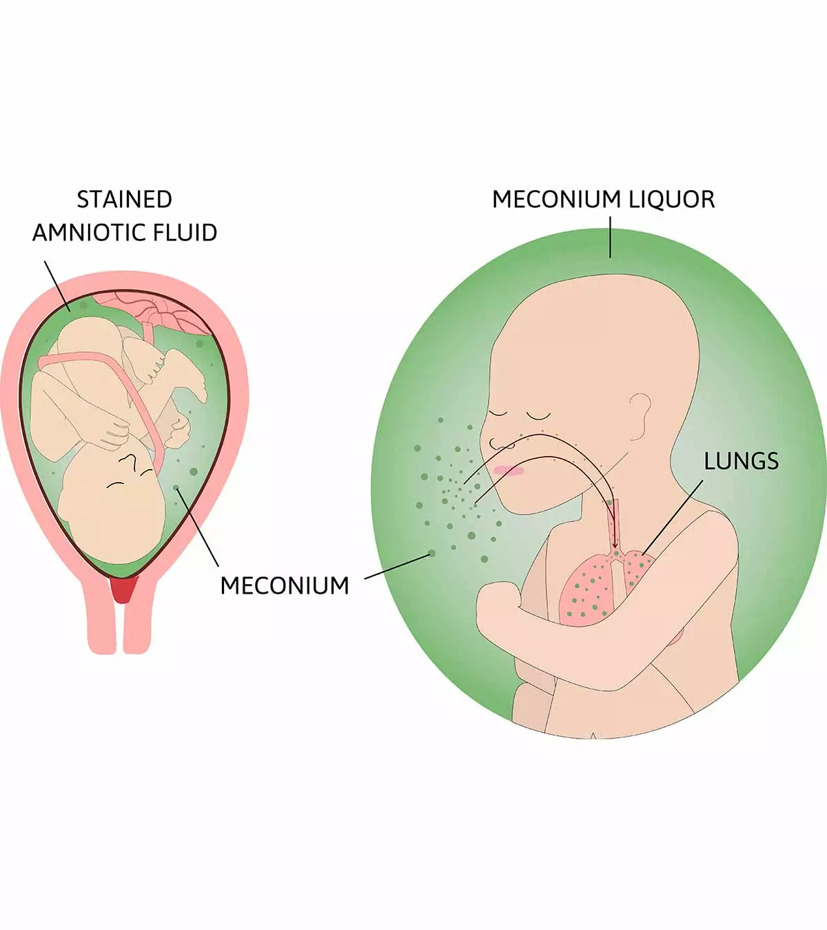 Although the prognosis is good, you may want to watch out for the risk factors.