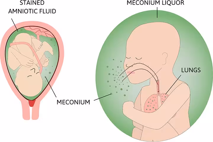 What is Meconium Aspiration Syndrome