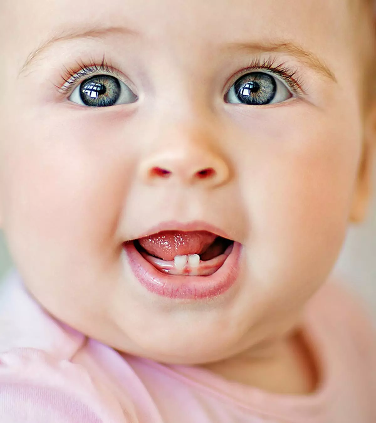 Extensive use of a pacifier and poor dental health care are common causative factors.