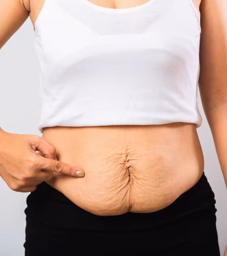 Diastasis Recti After Pregnancy In Hindi