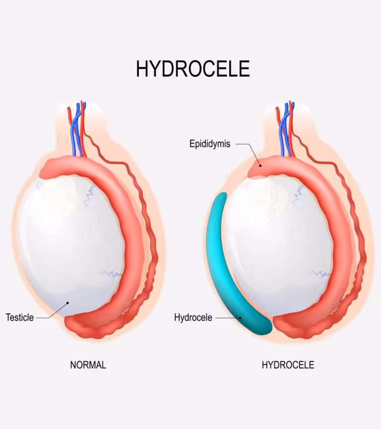 Hydrocele In Newborns Causes, Symptoms, And Treatment