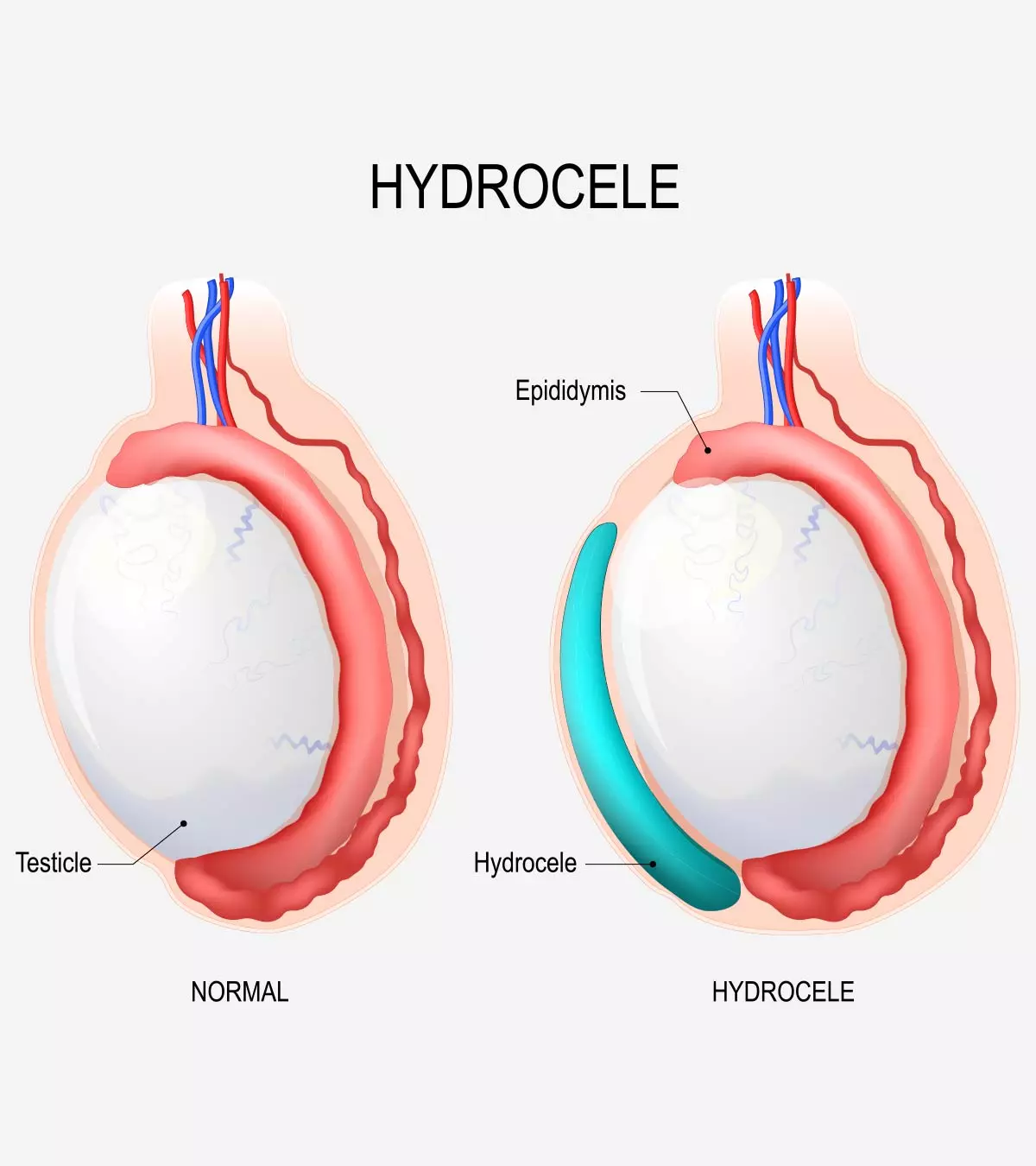 Nonclosure of the canal can cause smooth and painless swelling in the scrotum.