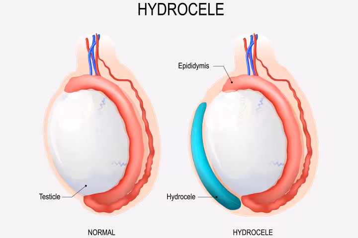 Hydrocele In Newborns Causes, Symptoms, And Treatment