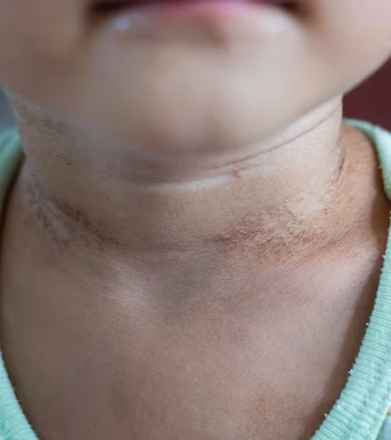 Psoriasis In Babies In Hindi