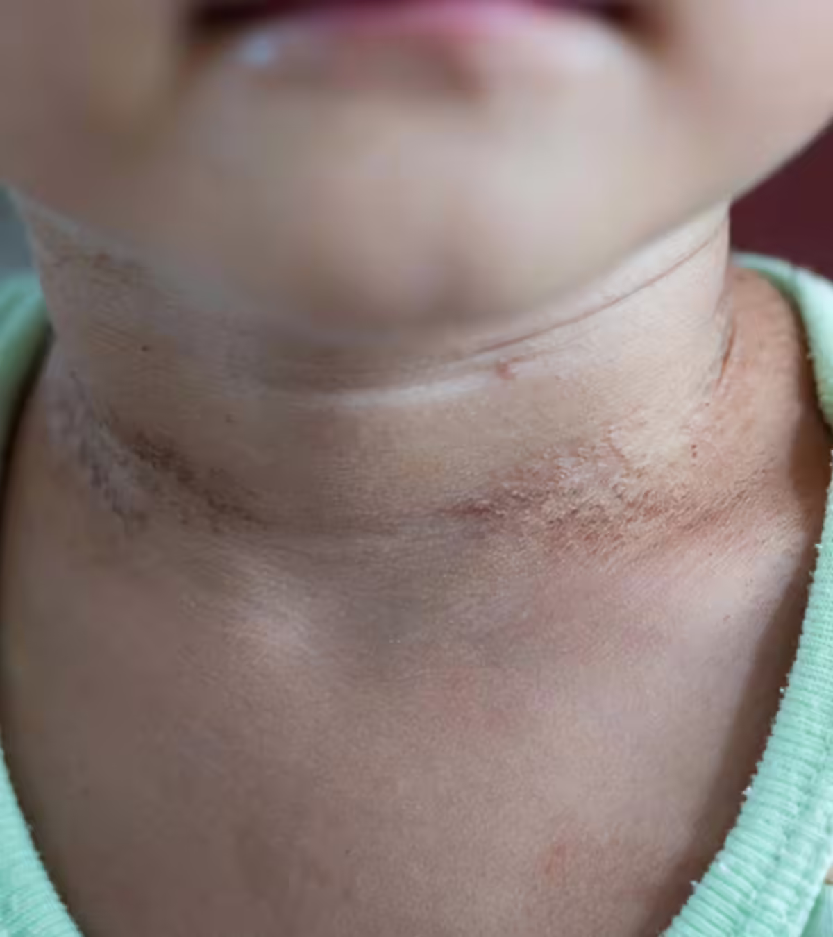 Psoriasis In Babies In Hindi