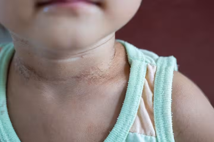 Psoriasis In Babies