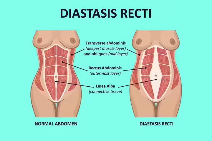 What is the problem of diastasis recti