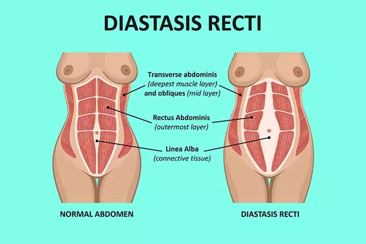 What is the problem of diastasis recti