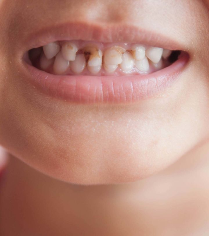 4 Causes Of Gingivitis In Children And How It Is Treated