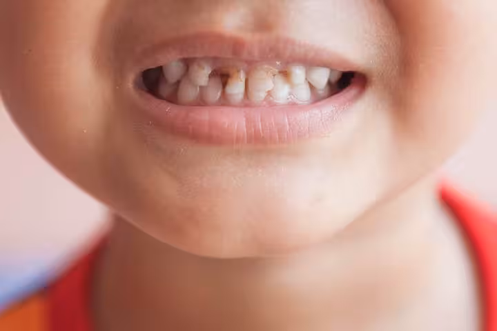 Gingivitis In Children Types, Causes, Symptoms, And Treatment