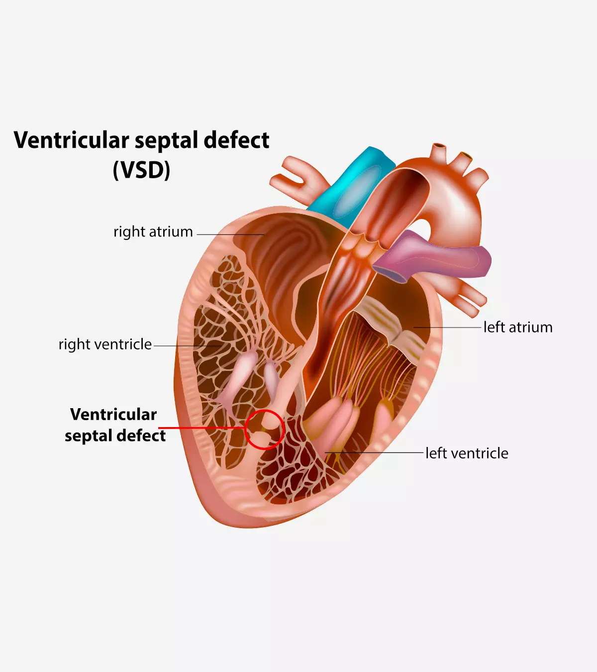 Breathing and feeding issues with tiredness can be a sign of ventricular defects.