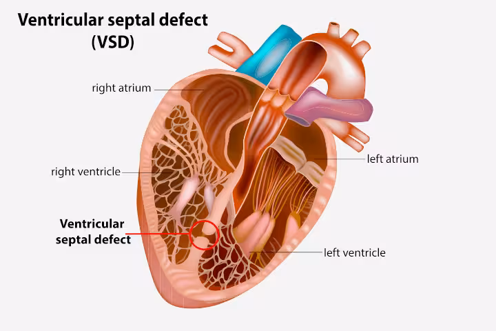 Ventricular Septal Defect (VSD) In Babies Signs