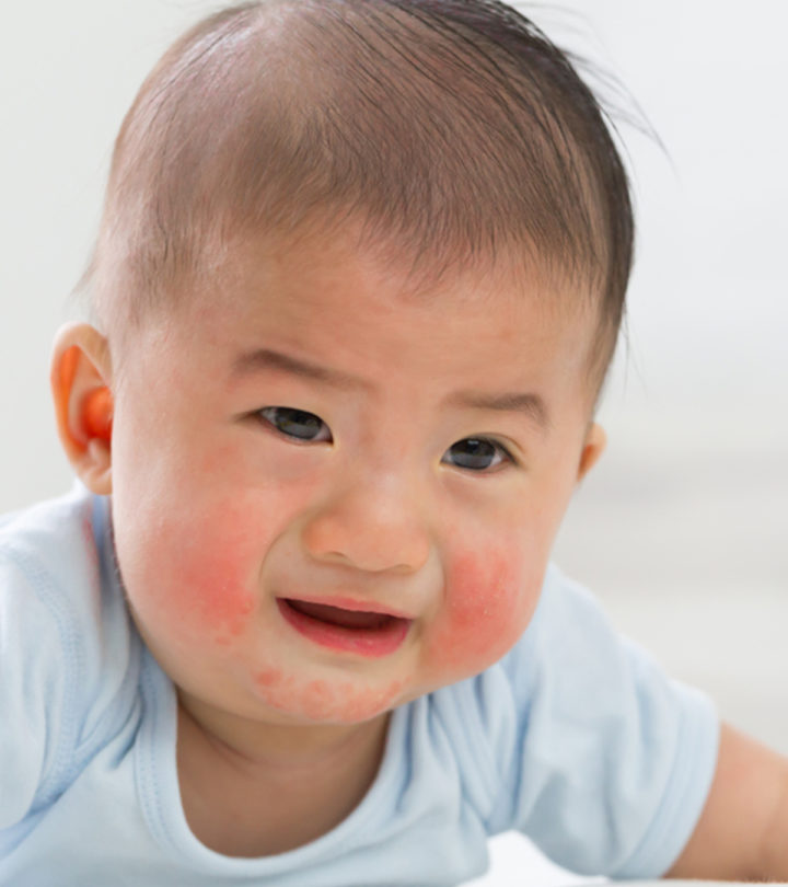 Types Of Baby Rash