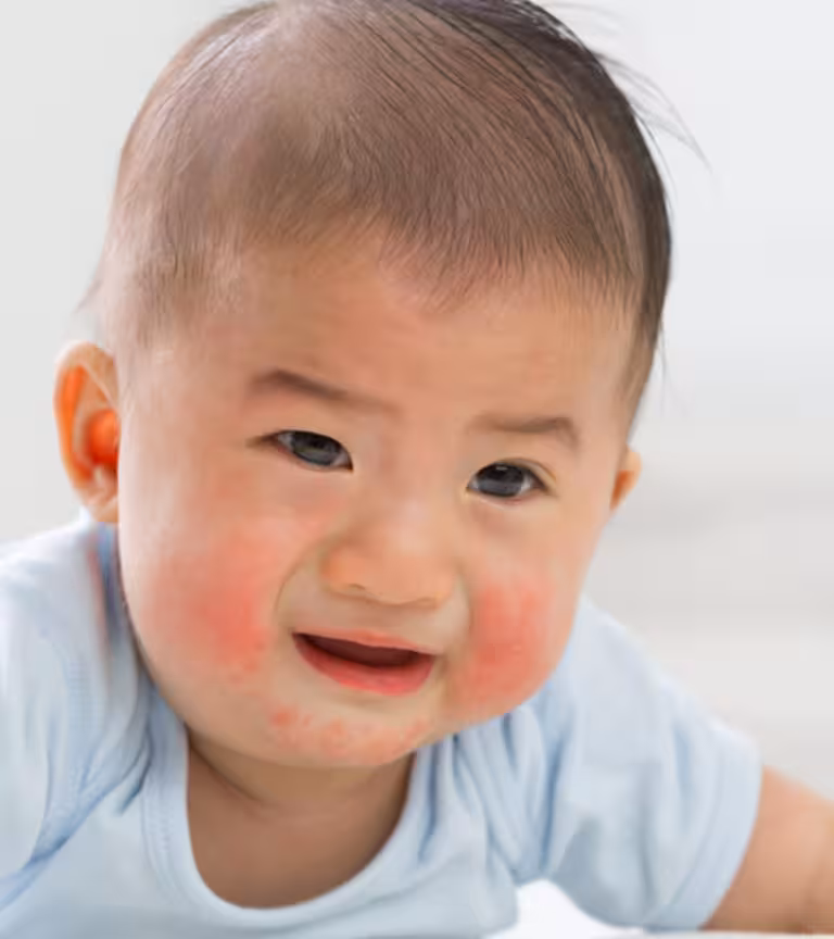 Types Of Baby Rash