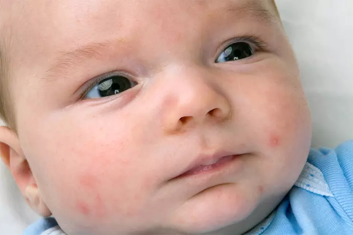 Baby Acne