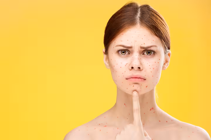Chickenpox in Pregnancy in Hindi