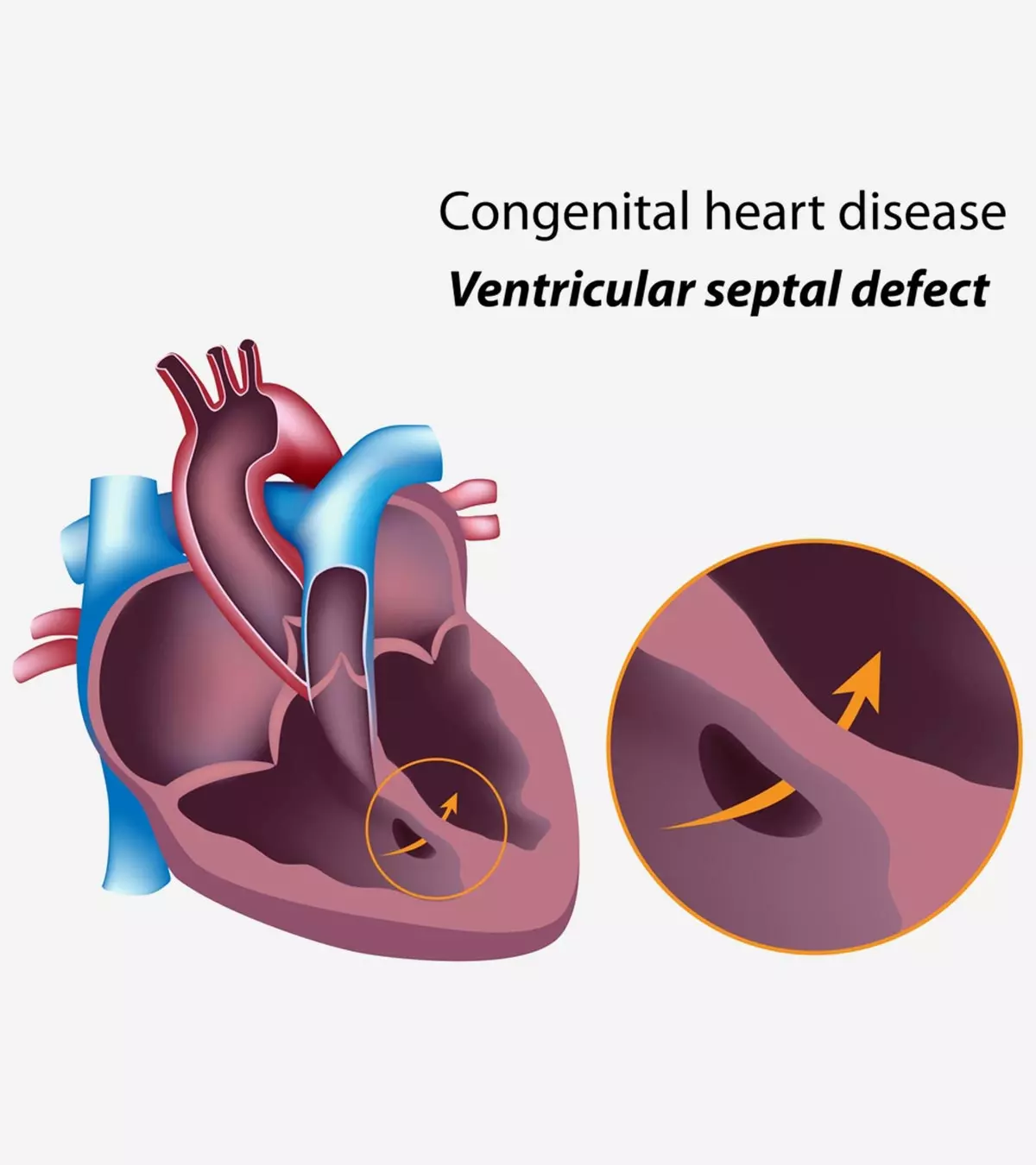 The symptoms often become evident in the first few months after birth.