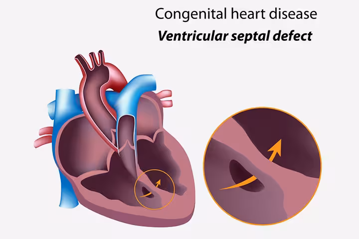 Congenital Heart Disease In Children Types, Signs, Causes, And Treatment