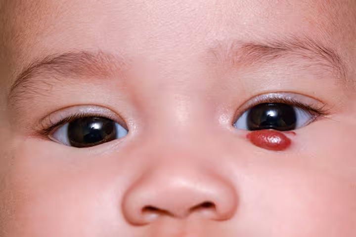 Strawberry Birthmark