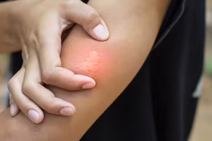 Appearance of bee stings on kids Appearance of bee stings on kids