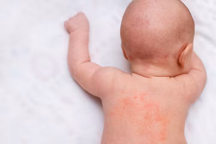 Anaphylaxis In Babies Symptoms, Causes And Treatment-1