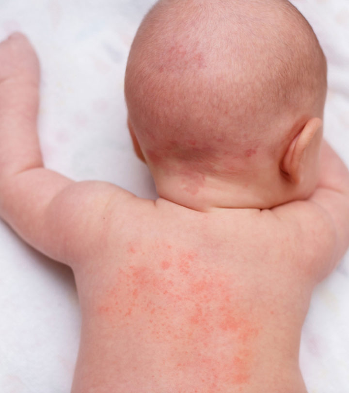 Anaphylaxis In Babies Symptoms, Causes And Treatment