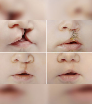 Baby With Cleft Lip (Palate): Types, Causes And Treatment