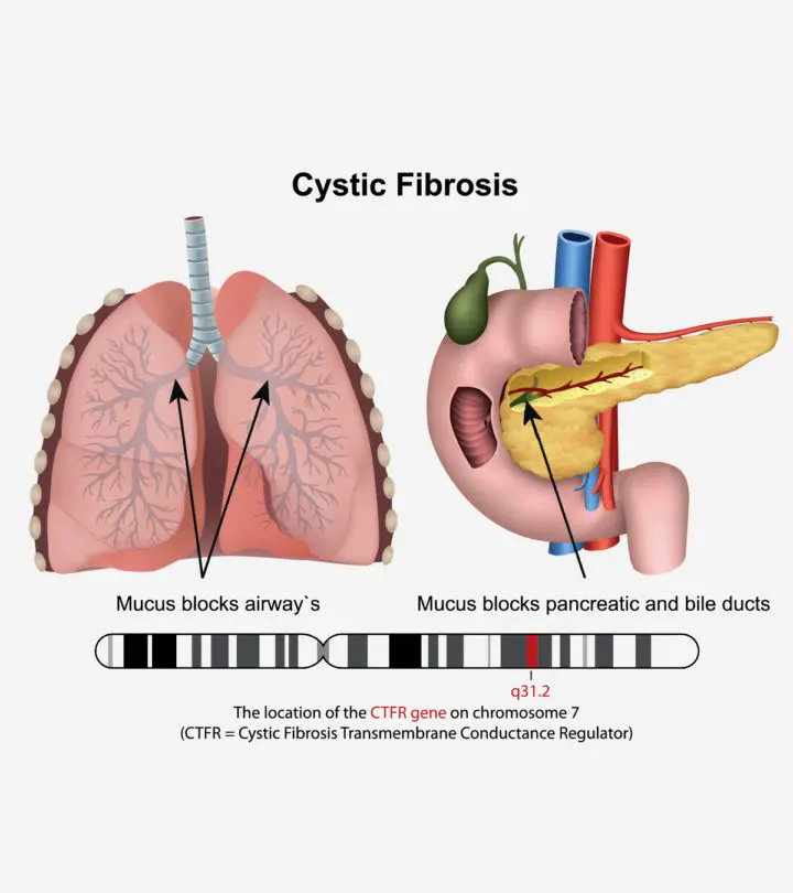 Cystic Fibrosis In Babies