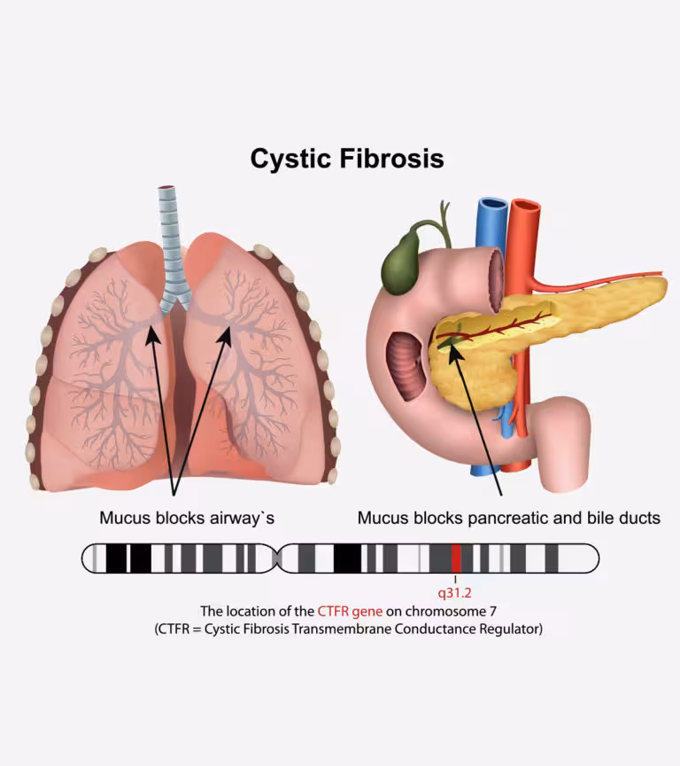 Cystic Fibrosis In Babies